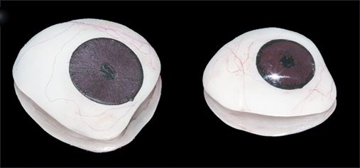 Reabilitação estética por meio de prótese ocular a base de PMMA – relato de caso