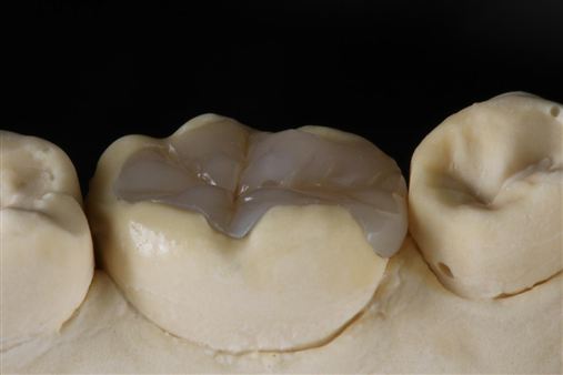 Técnica indireta com resinas compostas para uso direto para restauração de dentes posteriores: estratificação, escultura dental e polimerização adicional (Parte II).