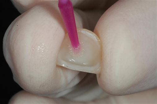 Restauração unitária de cerâmica em dente anterior: relato de caso.