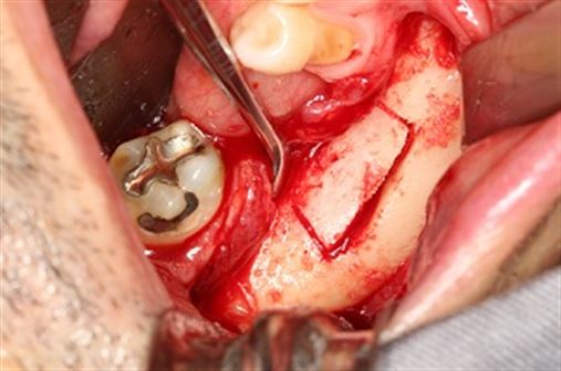 Enxerto interposicional na região posterior da mandíbula – relato de caso