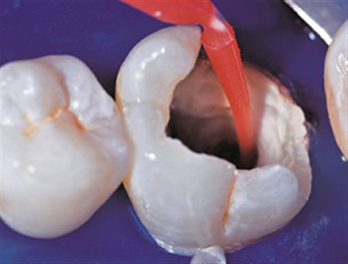 Abordagem multidisciplinar na restauração de um dente posterior extensamente destruído – relato de caso