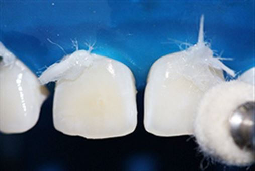 Enamel microabrasion as treatment of dental fluorosis in child – case report