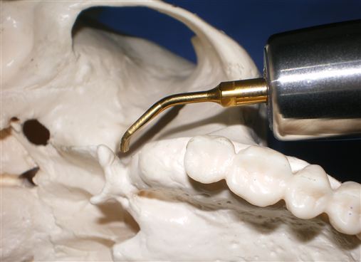 Piezocirurgia aplicada à cirurgia ortognática – estudo retrospectivo com descrição de nova técnica de piezo-osteotomia sagital da mandíbula