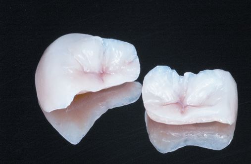 Técnica semidireta para reconstruções parciais em dentes posteriores –  relato de caso