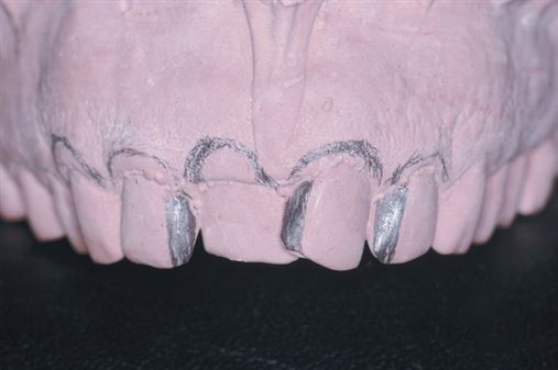 Alinhamento dental por meio de faceta cerâmica – relato de caso