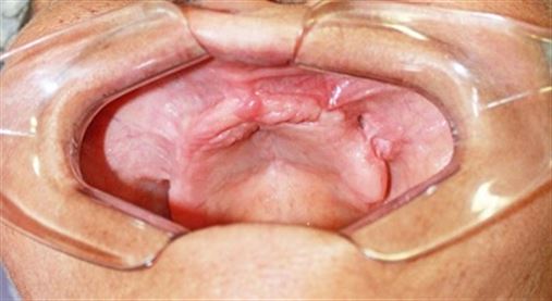 Tratamento de fístula bucossinusal com o uso de retalho do corpo adiposo de Bichat – relato de caso