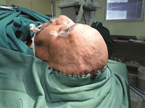 Tratamento cirúrgico de seio frontal através da cranialização e utilização do acesso bicoronal – relato de caso