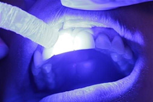 Restaurações cerâmicas em dentes anteriores comprometidos por erosão ácida – relato de caso