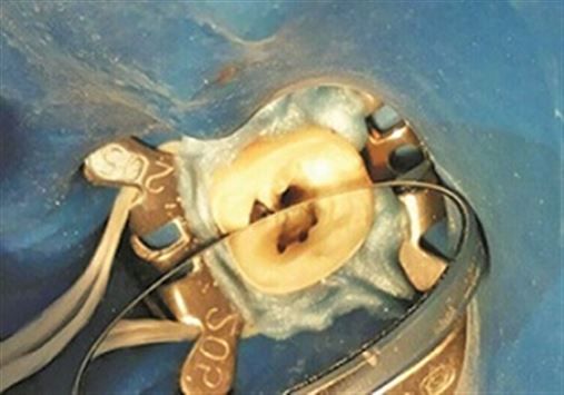 Localização e tratamento do canal médio-mesial em raízes mesiais de molares inferiores – relato de dois casos