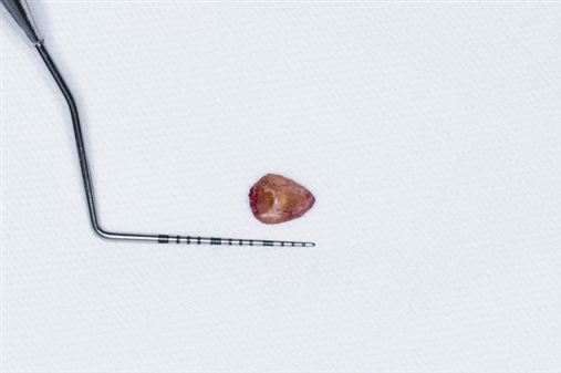 Tratamento cirúrgico de sialolitíase em glândula submandibular – relato  de caso