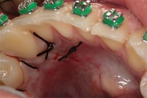 Remoção de dente extranumerário em vertente lingual de mandíbula – relato de caso