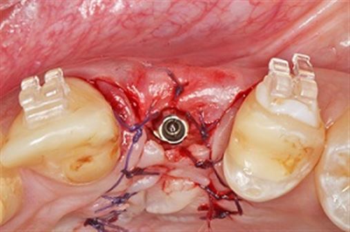Reabilitando implantes unitários com carga imediata em área estética