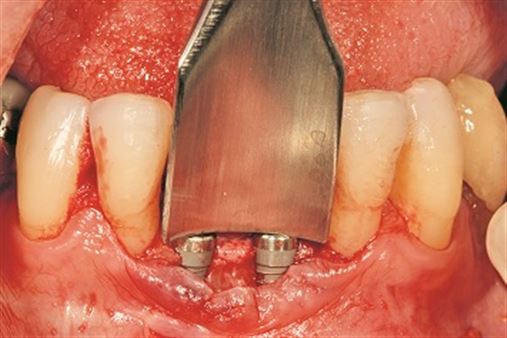 A versatilidade do uso da tuberosidade maxilar para pequenas reconstruções teciduais na Implantodontia