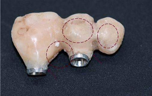 Manejo e adequação de prótese provisória sobre implantes