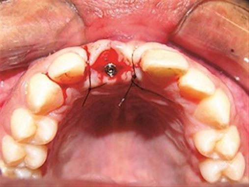 Manipulação gengival para harmonia gengivo-dental em reabilitação unitária anterior com implante – relato de caso
