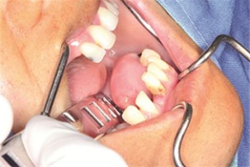 Osteoma periférico mandibular – relato de caso