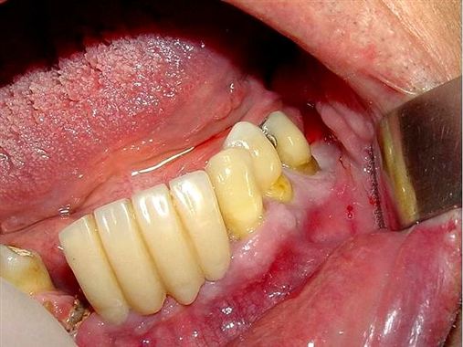 Enxerto de beta fostato tricálcio em corpo de mandíbula com lesão cística e instalação de implantes: relato de caso