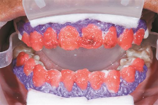 Abordagem conservadora na resolução de manchamentos severos por fluorose dentária através de clareamento dentário: associando técnicas