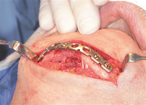 Tratamento da fratura de mandíbula atrófica associada à reabilitação com implantes dentários – relato de caso