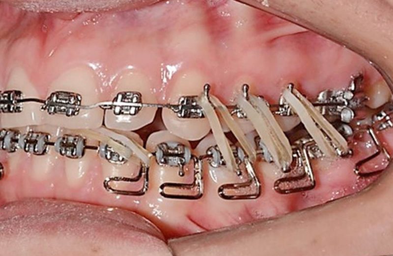 Mandibular molar space closure with anchorage through mandibular protraction appliance – case report