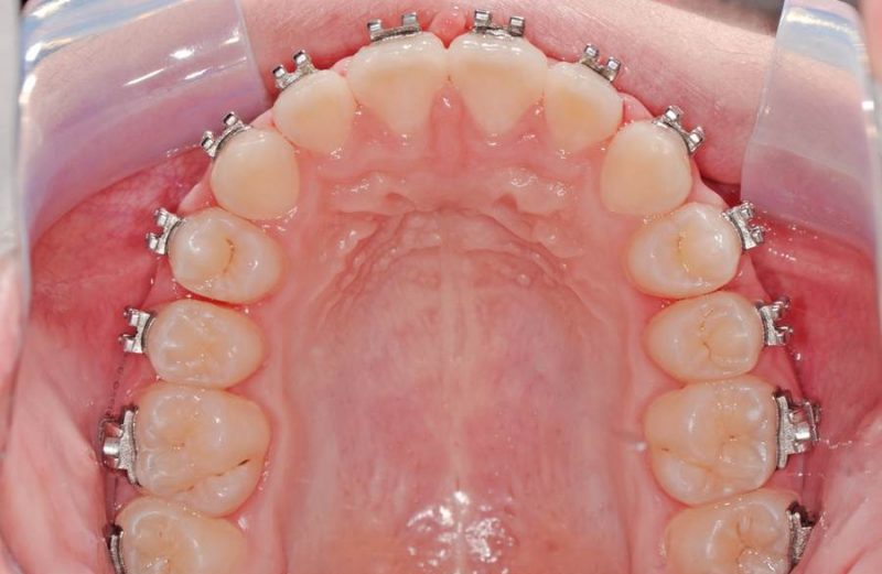 Clinical Excellence Column – Control of the shape of dental arches