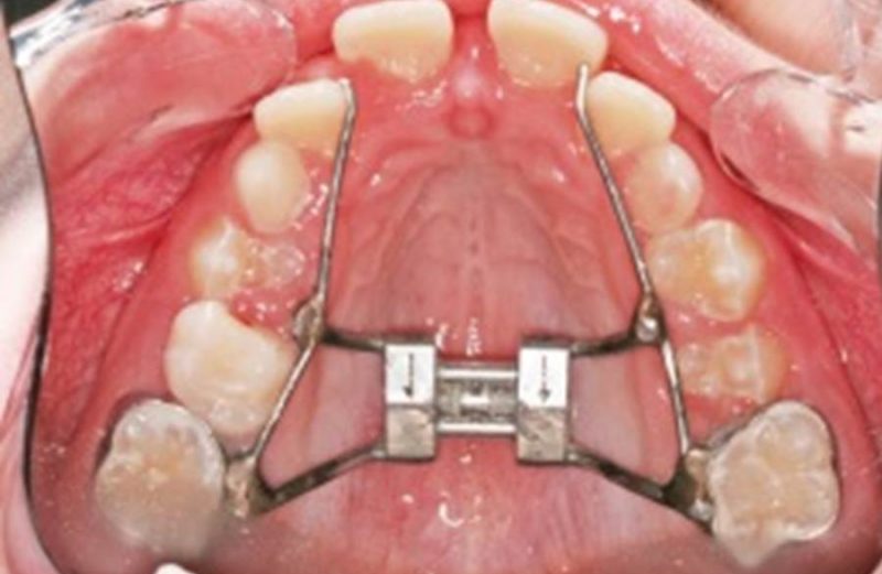 Tratamento ortopédico e ortodôntico em paciente infantil portador de mandíbula hipoplásica – micrognatia com controle de 5 anos