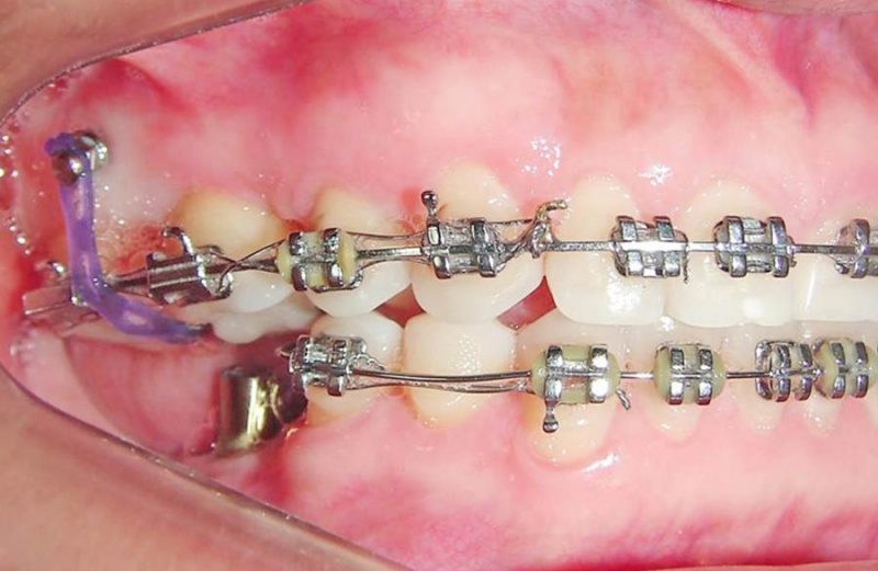 Abordagem interdisciplinar do tratamento em paciente adulto com múltiplas perdas dentárias