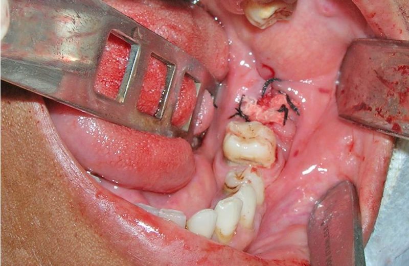 Exérese de cementoblastoma benigno em região do terceiro molar inferior esquerdo – relato de caso