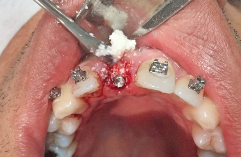 Reabilitação dentária anterior através da extrusão ortodôntica lenta e instalação de implante com provisionalização imediata – relato de caso