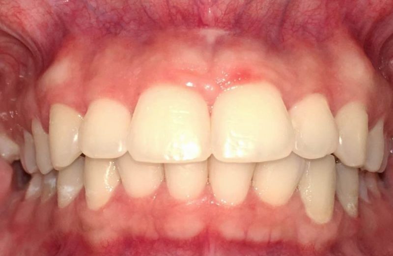 Manejo de fratura bilateral de mandíbula através de fixação interna rígida pela técnica de Champy – relato de caso