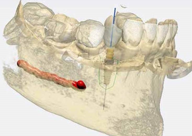 Cirurgia guiada de implante dentário – relato de caso