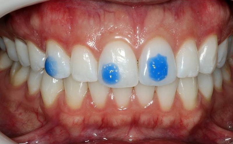 Protocolo clínico para la instalación de aditamentos en casos tratados con alineadores de ortodoncia – descripción de la técnica