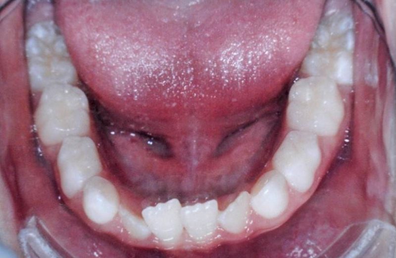 Abordagem ortodôntica de anquilose resultante de traumatismo dentário – relato de caso