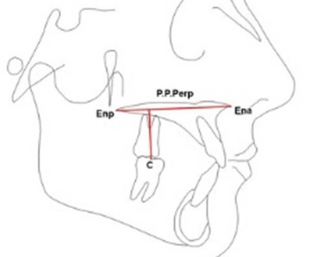 Altura alveolar posterior – proposição de um fator cefalométrico