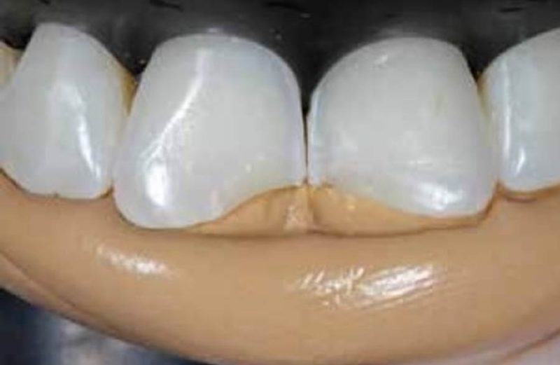 Reabilitação estética de dentes anteriores fraturados