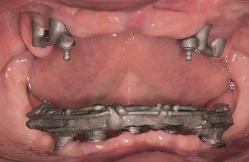 Overdentures – parameters for a rehabilitation planning in dental maxila – case report