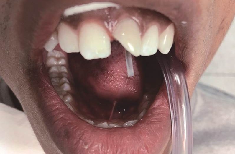 Tratamento e reabilitação estética em dente anterior traumatizado com rizogênese incompleta – relato de caso