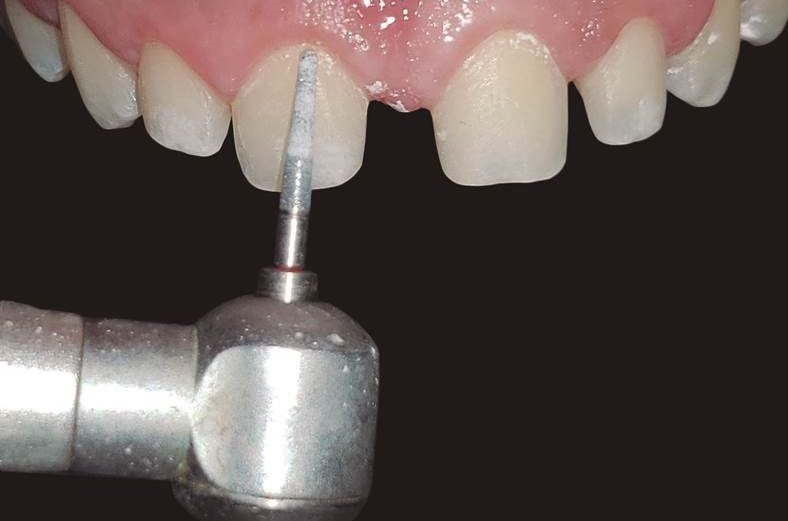 Periodontal and prosthetic approach to diastema closure – case report
