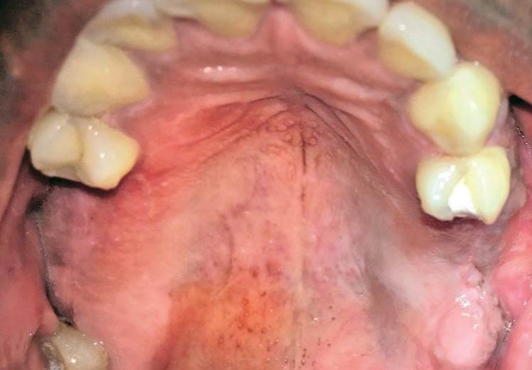 Management of oroantral communication using buccal fat pad – case report