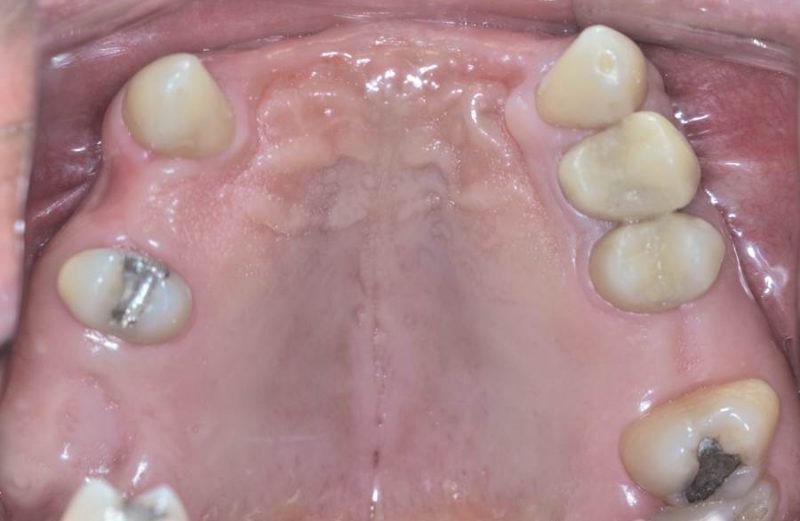 Um novo conceito na obtenção do guia prototipado em Implantodontia – relato de caso