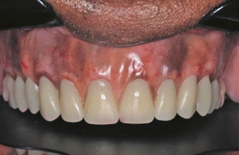 Use of high-intensity diode laser for pre-prothetic frenectomy and bridectomy for increased retention in complete denture in a diabetic patient – case report