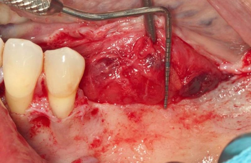 Coluna Grois – Região posterior de mandíbula – Como executar a Sausage Technique com previsibilidade?