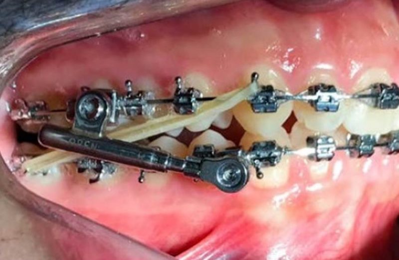 Coluna Ortodontia e Ideias: Tratamento de má oclusão Classe II com propulsor mandibular em paciente adulto – relato de caso