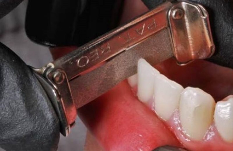 Protocolo clínico de desgaste interproximal en el tratamiento con alineadores de ortodoncia