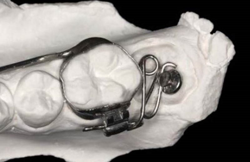 Mecânica simples e eficaz para desimpactar molares inferiores na dentição mista