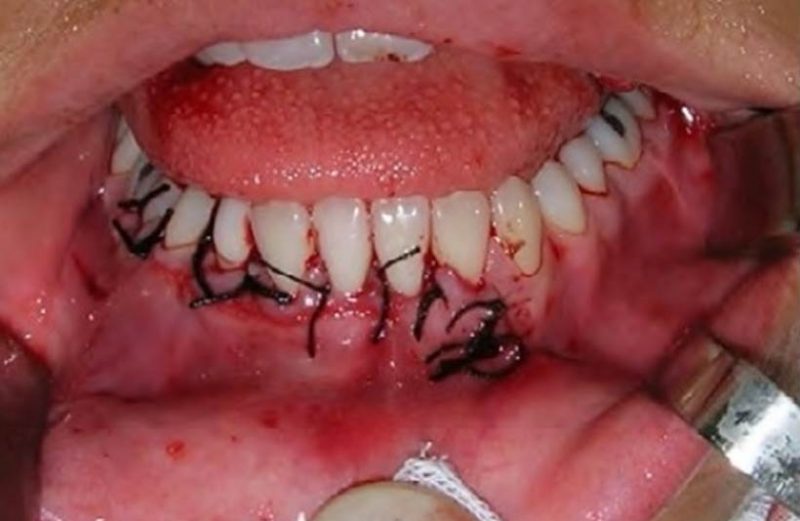 Cisto odontogênico calcificante (COC) – relato de caso