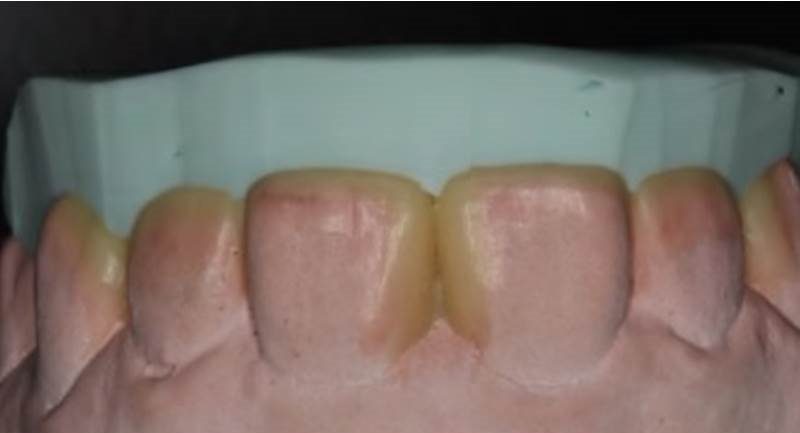 Diastemas closure and aesthetic approach with direct composite resin