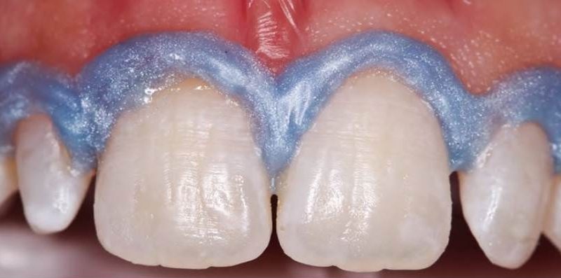 Reanatomization of conoid lateral incisors with silicon palatal guide – a case report