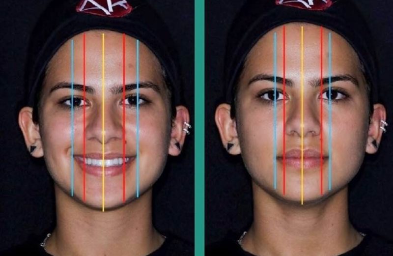 Análise facial: A primeira etapa para a Harmonização Orofacial