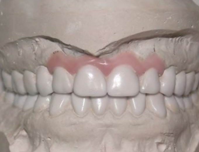 Recuperação da dimensão vertical de oclusão: sua importância na reabilitação oral dos pacientes com fissuras labiopalatinas